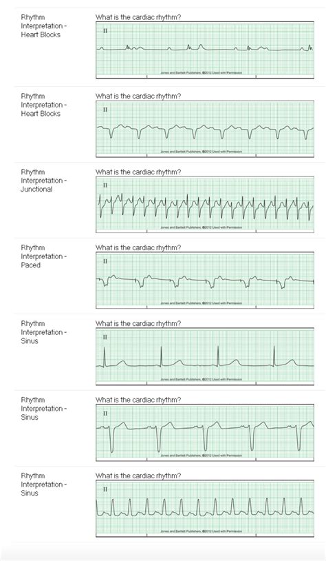The discussion of <strong>EKG</strong> changes with an acute myocardial infarction is by far the most sophisticated overview for providers. . Jones and bartlett 2012 ekg strips